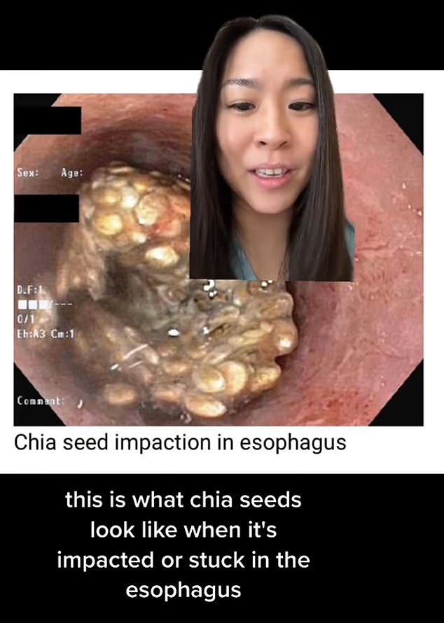 Dr.  Wendi LeBrett, a gastroenterologist at UCLA Health in California, took to TikTok to talk about how the seeds can get stuck in the esophagus