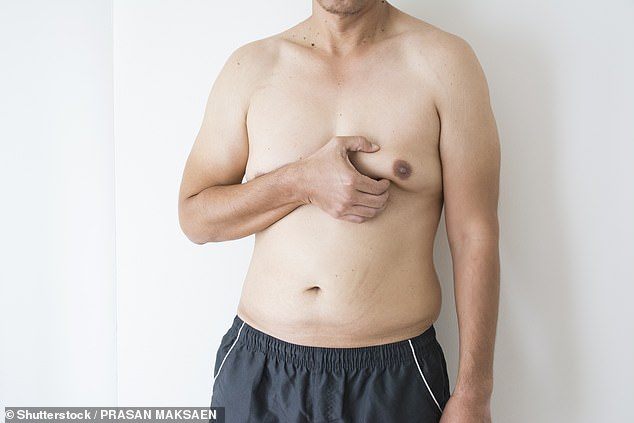 Men with gynecomastia – a condition that causes breasts to swell – are a third more likely to die by age 75 compared to non-sufferers, researchers found