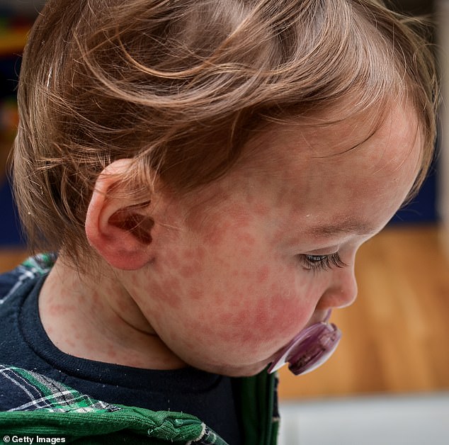 Measles is especially dangerous for pregnant women and children under two years of age, who naturally have weaker immunity