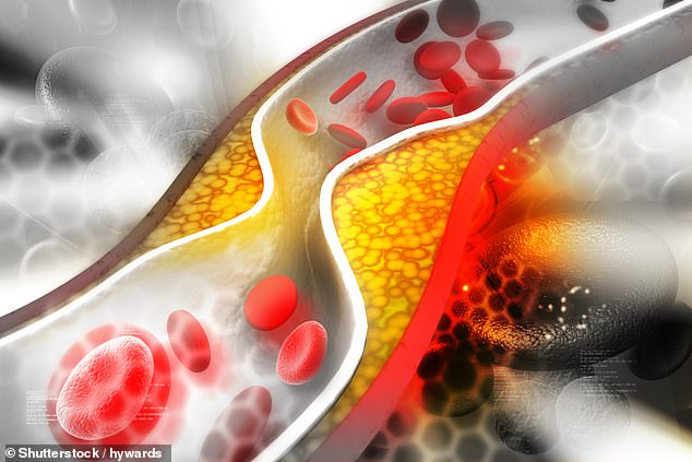 The above shows cholesterol plaque in an artery