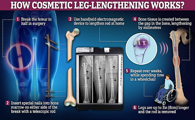 The amazing procedure works by breaking at least two leg bones in half.  Nails are then drilled into both ends of each femur and shin bone, which are slowly pulled apart with magnets, resulting in a longer bone over a period of a few weeks.  But it can leave patients in pain and wheelchair-bound during the process, requiring months of physical therapy