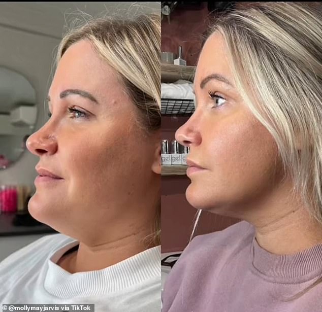 Above is a woman before she received Lemon Bottle injections on her chin, to the left of the results after the injections