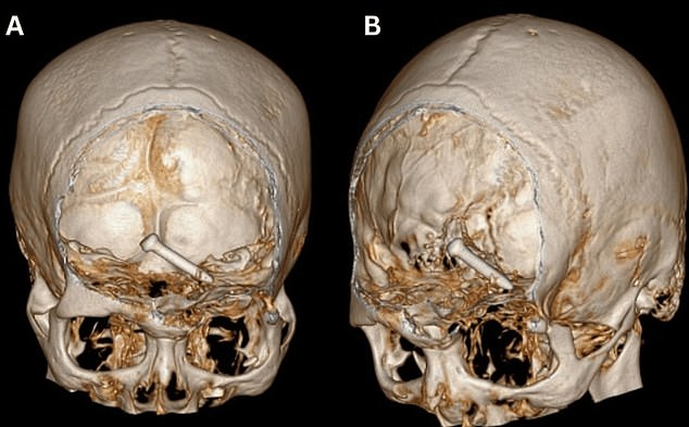 It missed his left eyeball by millimeters but still penetrated the frontal lobe of his brain, fracturing his eye socket.  However, medics removed the nail completely.  Experts said he was very lucky not to suffer nerve damage or lose his eye