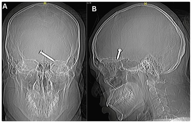 Doctors in Malaysia shared gory details of the incident in a medical journal, telling how the unidentified 30-year-old temporarily lost his sight.  The man, who was working on a construction site, was not wearing safety glasses.  After his nail gun jammed, he checked the gun barrel before accidentally firing the power tool