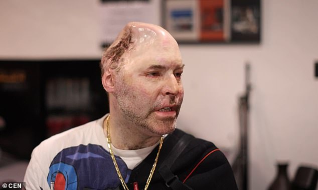 Niko Brenner (pictured), a rapper who lost nearly half his skull after an explosion in a drug laboratory while cooking a concoction called 'Nazi Gold', faces five years in prison in Germany