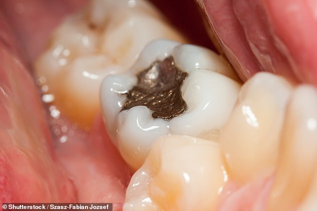 The European Parliament is about to ban dental amalgam, used in common silver fillings, over fears of its toxicity