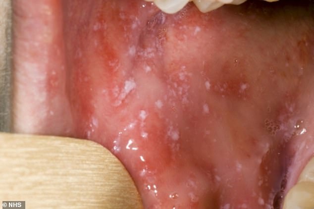 White spots in the mouth also often appear a few days after the first symptoms.  These last a few days