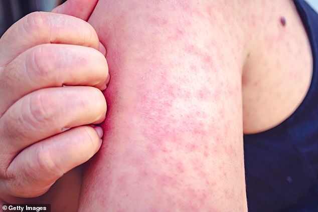 Measles usually starts with cold symptoms before causing a rash consisting of small red spots, some of which may feel slightly raised.  According to the NHS, it usually starts on the face and behind the ears before spreading further