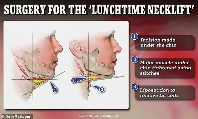 Above you can see how the neck lift surgery was performed