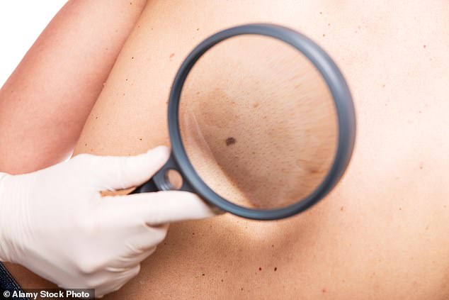 Malignant melanoma is a serious form of skin cancer that starts in the melanocytes (file image)