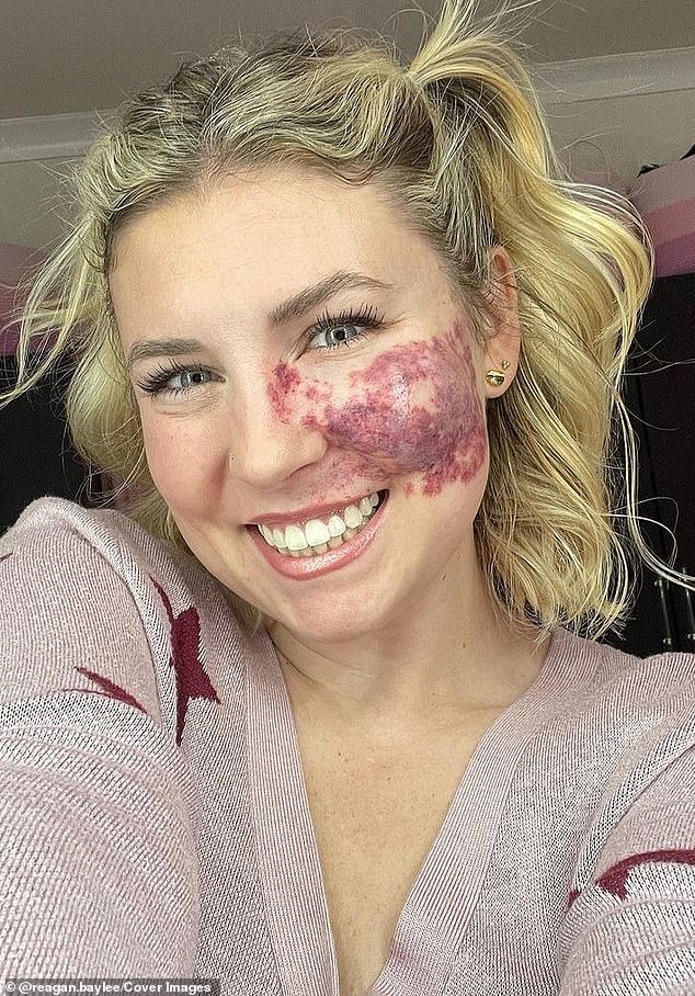 Reagan Baylee, from Los Angeles, is using her social media platforms to shed light on her port wine stain birthmark