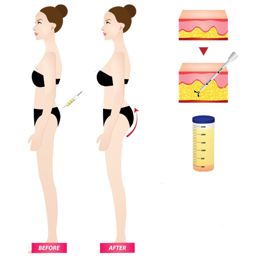 The Ultimate Guide to a Brazilian Butt Lift Before and After Surgery