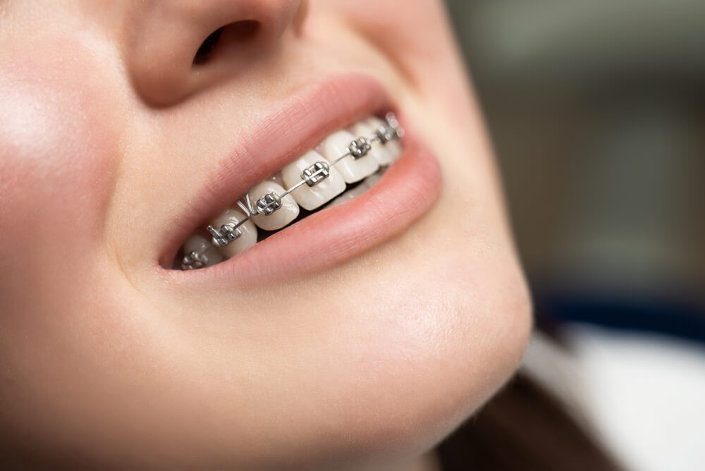 Understanding the Different Approaches of Comprehensive Orthodontic Treatment