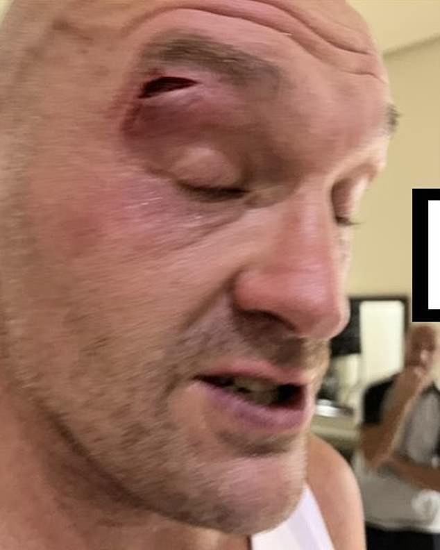 Fury suffered this bizarre cut during a sparring accident that has affected the entire card, including the Opetaia fight