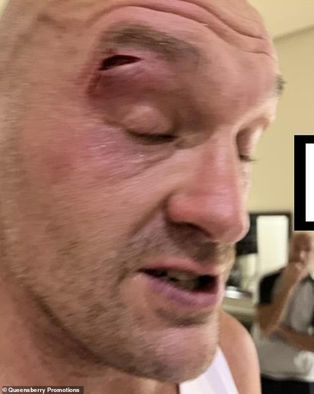 Fury suffered a nasty laceration above his right eye, which has postponed his next fight