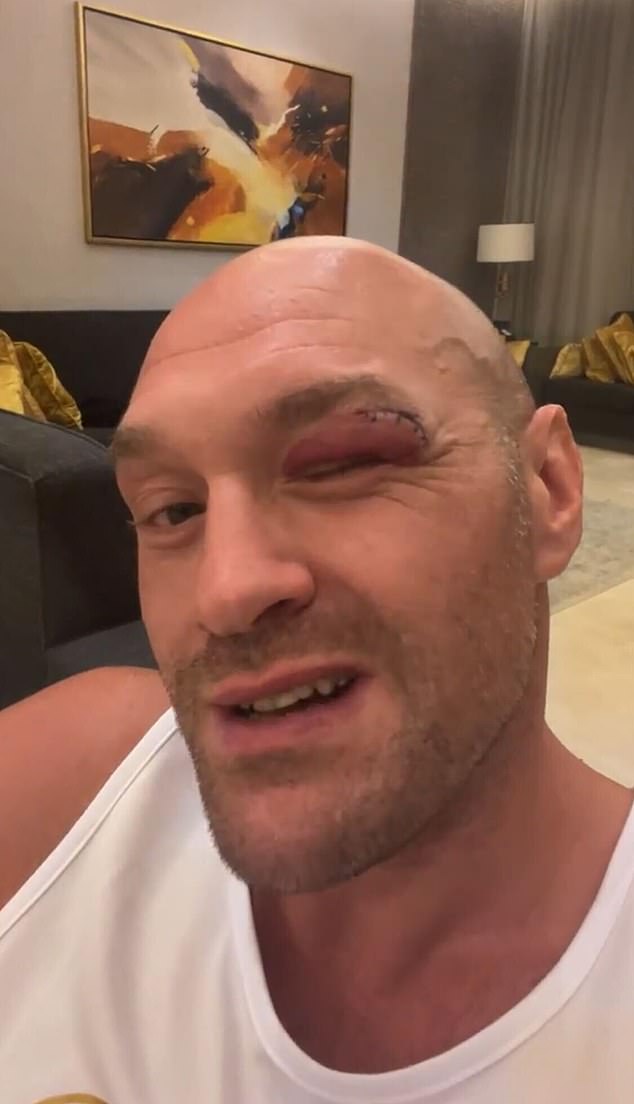 Fury said in an Instagram video that he was caught with an elbow that almost cost him the 