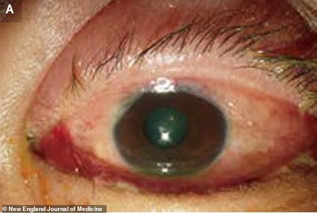 Pressure on the eye caused the blood vessels to rupture, leading to bleeding