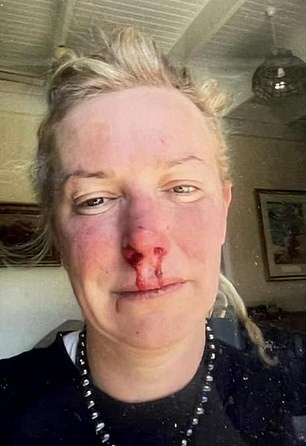 Ms Buttrose shared images of her bloodied nose and chin on social media