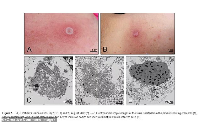 The unidentified, immunocompromised man died in late January, officials said in a bulletin Friday — weeks after he became the seventh person ever to contract the virus.  Illustrations from an article entitled 'Novel Orthopoxvirus Infection in an Alaska Resident'