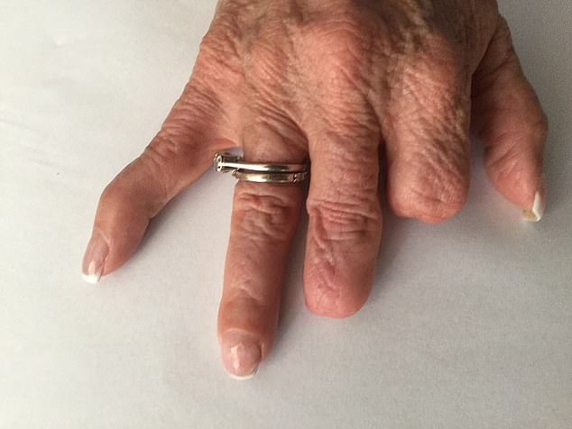 A 62-year-old British woman living in Spain has told how her fingers had to be amputated after she suffered septic shock