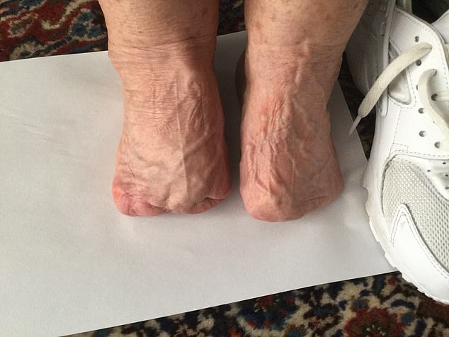 A British expat, who has since returned to Britain, had to have part of her feet amputated after her skin started to 'rot'