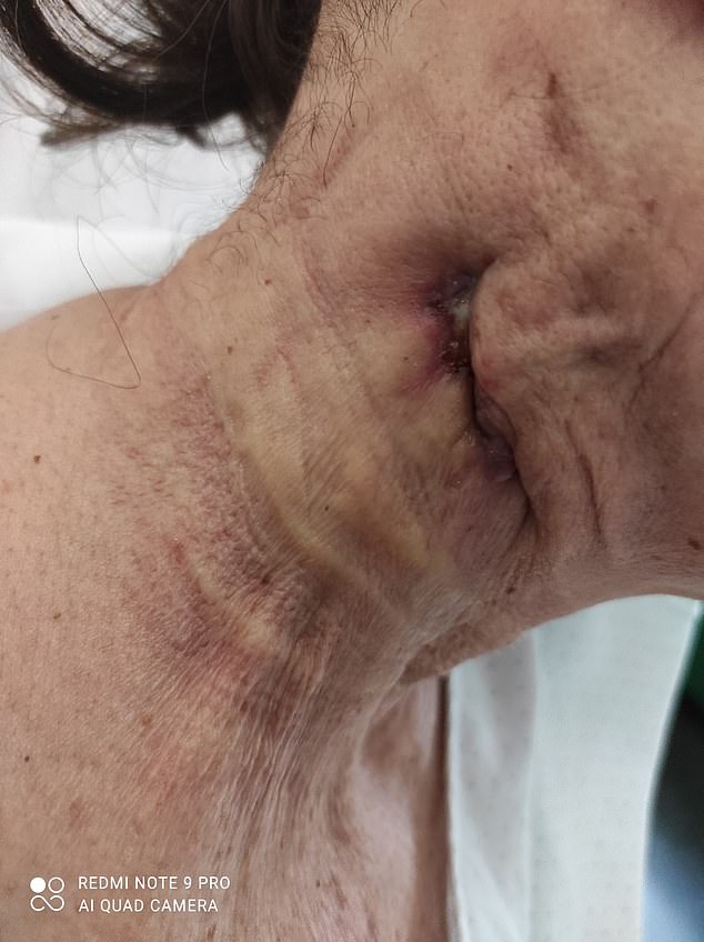 Irish patient said she was 'disfigured with a huge ugly scar on my neck'