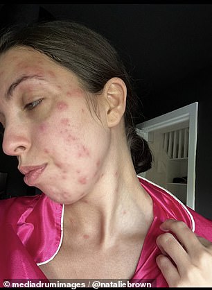 Natalie Brown (pictured), 28, was covered in bedbug bites after spending three days on holiday in Benidorm, Spain