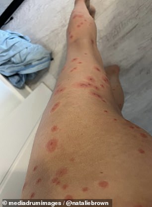 Her reaction to the bites was so severe that Mrs. Brown required a course of antibiotics to clear her inflamed and itchy skin