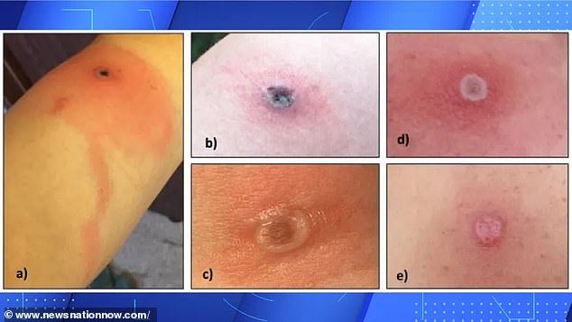 Health officials recommend covering any skin lesions that develop and not touching the painful area.  The immunocompromised man first noticed a red bump in his armpit in September 2023 and was prescribed antibiotics after visiting the emergency room