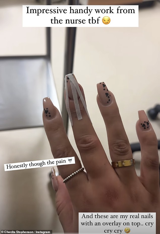 She explained: 'I fell off a stall and had a freak accident where I must have actually fallen on my nail'