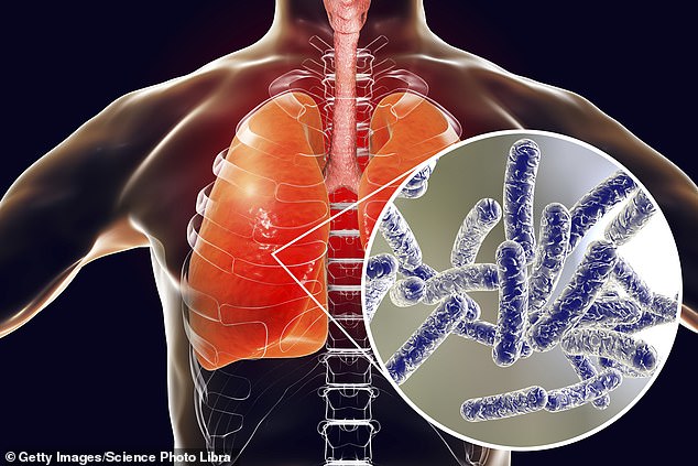 Legionnaires' disease is a serious form of pneumonia caused by the bacteria Legionella