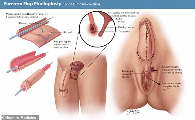 A phalloplasty procedure, as described in a medical textbook