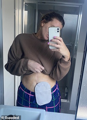 On December 1, Kate underwent a major five-hour operation to remove the tumors from her ovaries and reconstruct the intestines, leaving her with an ileostomy ostomy bag.