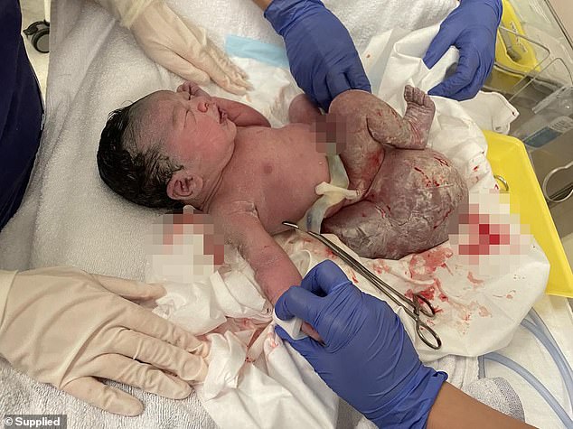 After delivery, the baby was immediately taken to an operating room for a gruesome, six-hour operation to cut out the teratoma.