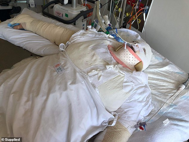 She suffered severe burns to the upper half of her body, including her lungs, and has been in an induced coma since (pictured)