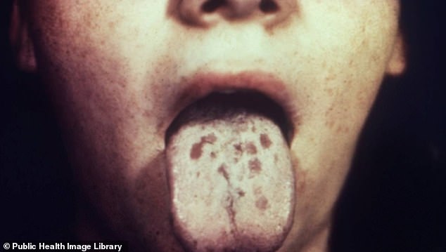 Diseases such as syphilis (pictured) and gonorrhea were once death sentences, but with the introduction of penicillin as a drug in the 1940s they became easy to treat