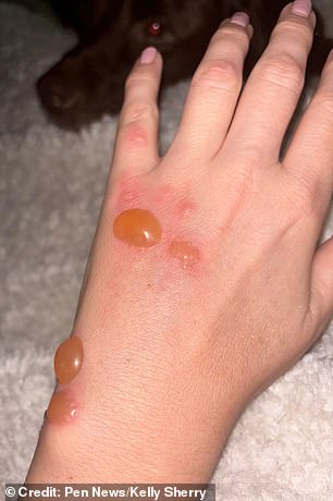 The next day her skin showed painful blisters