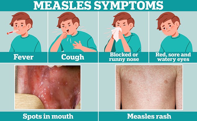 Cold symptoms, such as fever, coughing and a runny or stuffy nose, are usually the first sign of measles.  A few days later, some people develop small white spots on the inside of their cheeks and the back of their lips.  The characteristic rash of measles also develops, usually starting on the face and behind the ears, before spreading to the rest of the body.