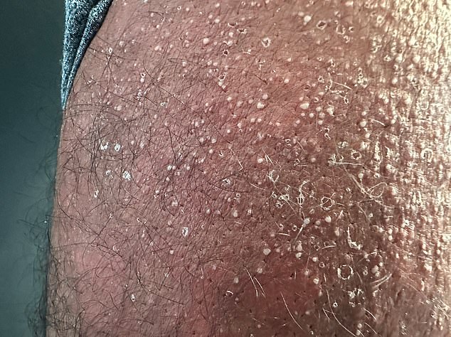 The 40-year-old developed pustules - small bumps on the skin containing fluid or pus - covering his chest, face and thighs after taking tadalafil, sold as Cialis in Britain.  In the photo, pimples on his thigh