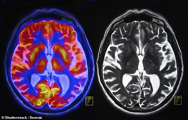 Scientists have long debated whether sex differences exist in the brain.  This new study suggests this is possible, if scientists look in the right places