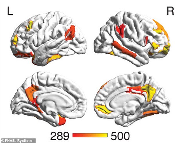 This image from the new study shows which parts of the brain are most important in distinguishing between men and women: the striatum and areas involved in the default mode network and the limbic network