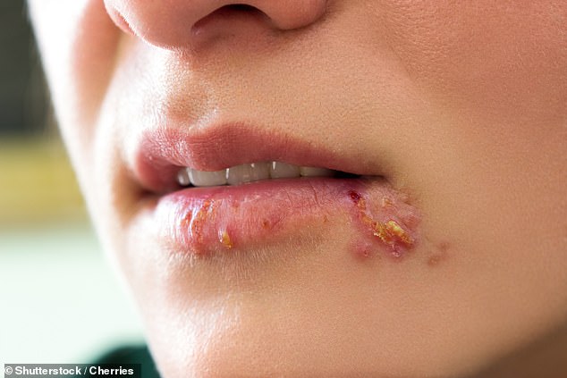 Researchers found that people infected with the herpes simplex virus – which causes cold sores – were twice as likely to develop dementia at some point in their lives, compared to those who were never infected.