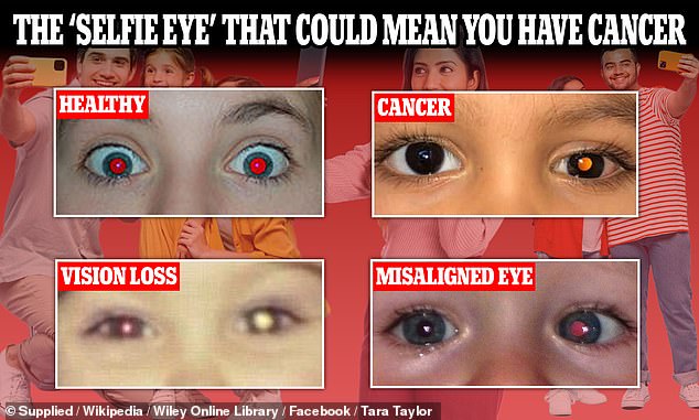 The above image shows different eye colors in photos with their meanings.  In the upper right, the pictured eye could indicate a rare childhood cancer – retinoblastoma – and in the bottom left, the pictured white eye could be a sign of a disease where blood vessels leak into the eye.