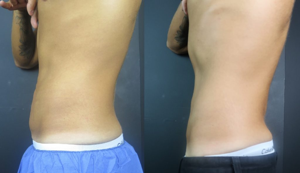 coolsculpting belly fat before and after 1024x590 1