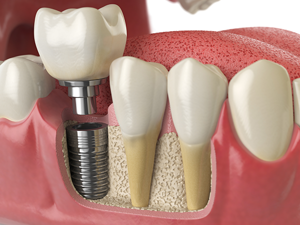 phoenix dental implants