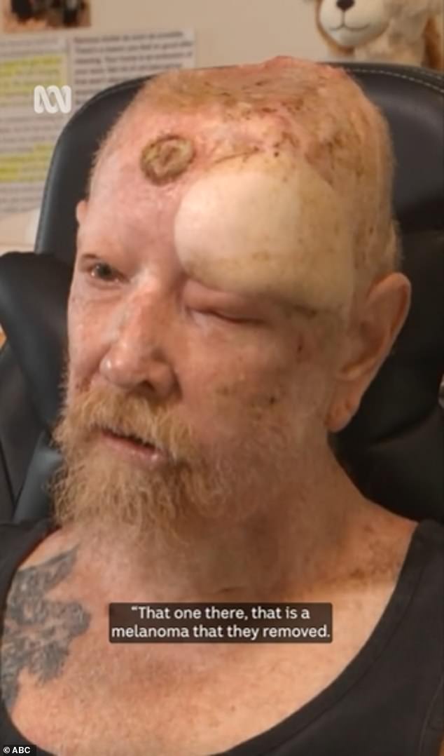 Nearly 200 skin cancers have been removed from his body, four of them melanomas, leading to chemotherapy and numerous surgeries on his skull.