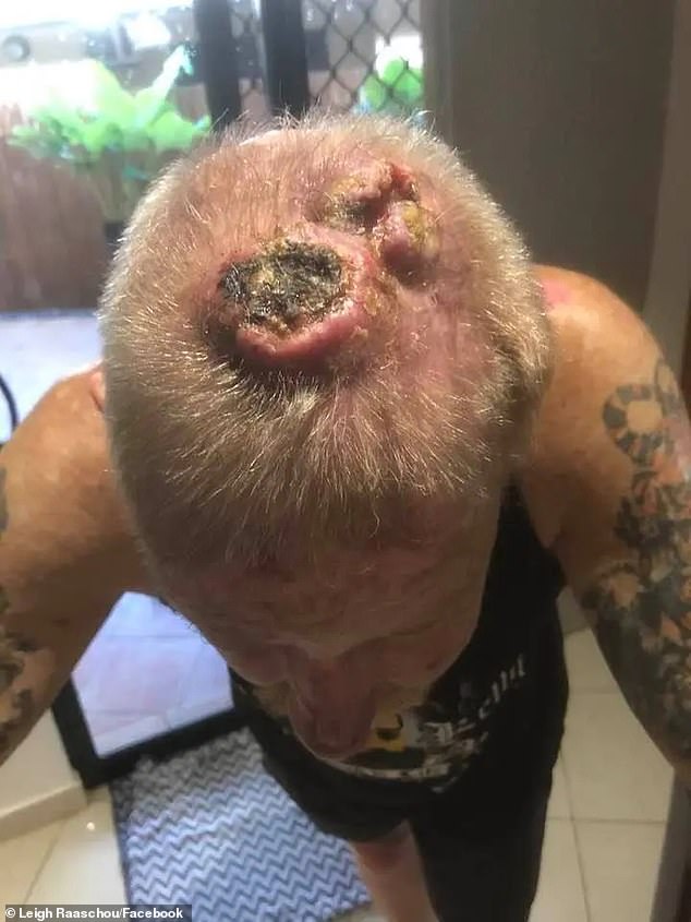 He lost parts of his skull due to the cancer