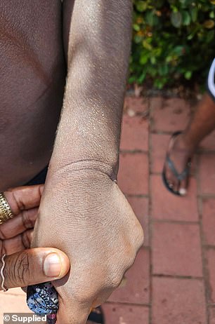 Pictured: Cable tie marks on Stuart's wrist