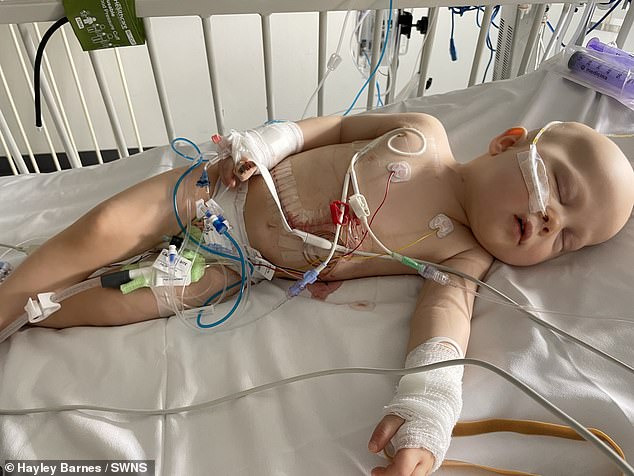 Jaxon also underwent surgery to remove part of his liver.  A year after his diagnosis, in August 2023, he was subsequently declared cancer-free.  Pictured is Jaxon Barnes, 2, after a life-saving liver resection at Leeds General Hospital