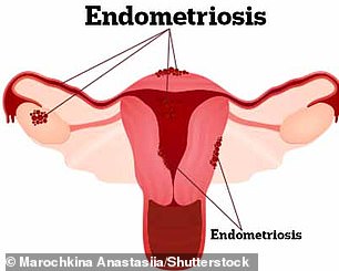 Endometriosis is a condition in which tissue similar to the uterine lining grows in other places, including the ovaries, fallopian tubes, and intestines.